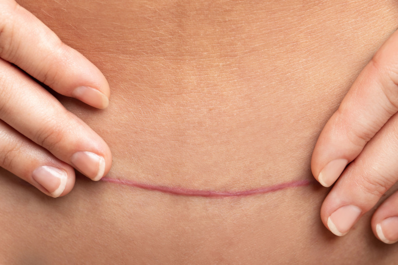 C-Section Pregnancy Scars: Prevention, Management, Causes & Types